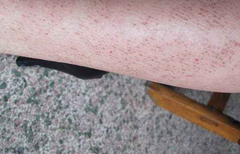 皮膚澱粉樣變 (7) 