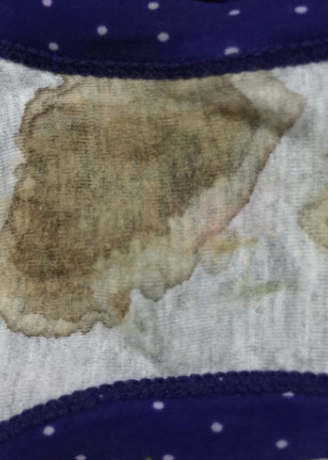 白帶帶有褐色分泌物 (57) 