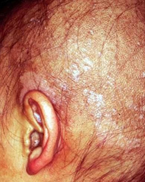 頭上的放射性皮炎