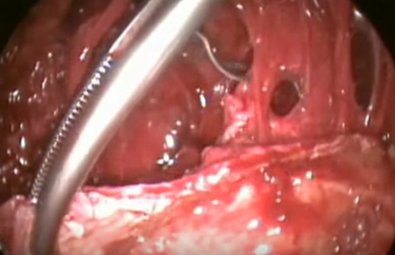 結核性胸膜炎做穿刺