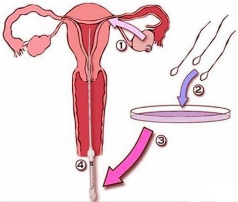 人工受完孕的過程 (45) 