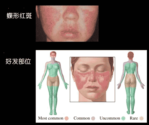 系統性紅斑狼瘡診斷標準 (9) 
