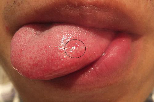 舌癌的初早期症狀