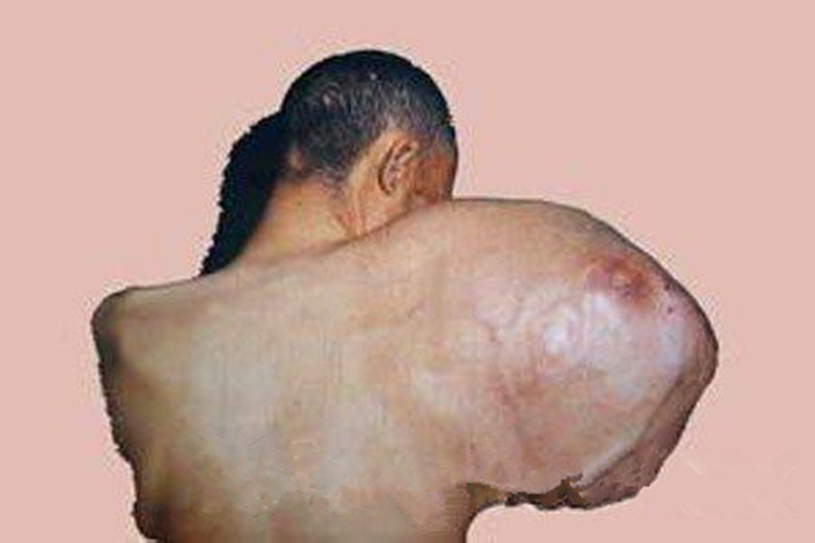 右肩惡性骨肉瘤