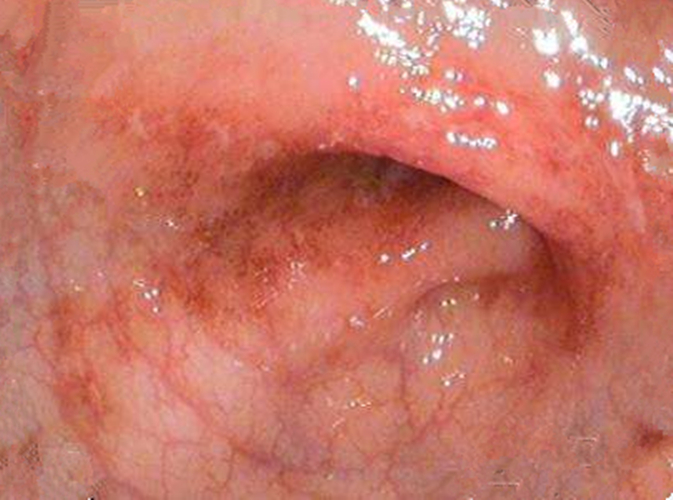 什麼會導致慢性結腸炎的發生的