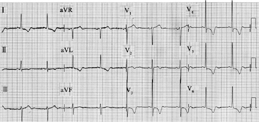 高鉀血癥心電圖 (57) 