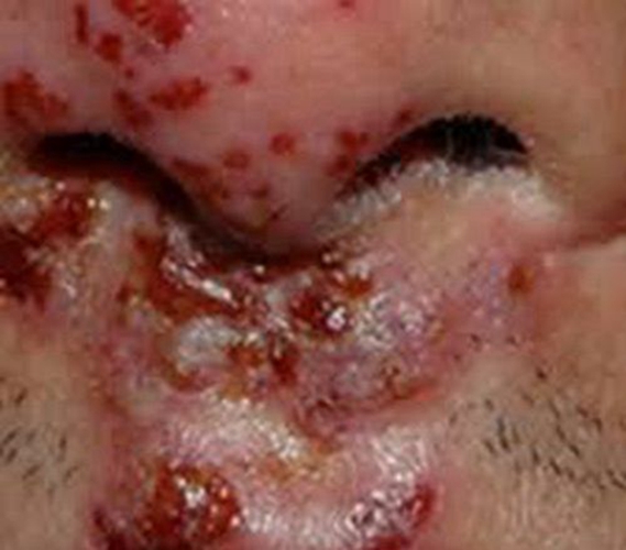 口唇皰疹結黑痂