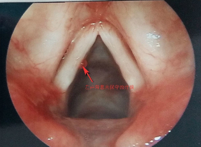 左聲帶息肉保守治療前的