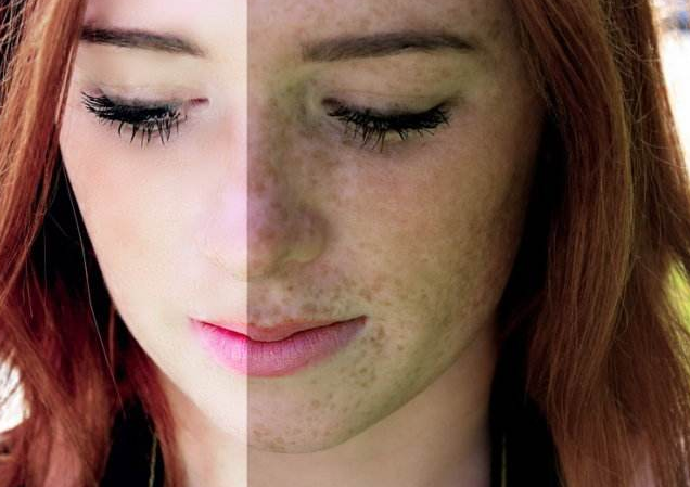 磨皮手術效果圖 (50) 