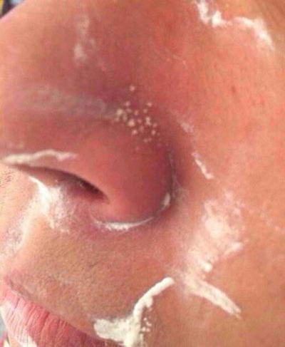 鼻子長蟎蟲症狀