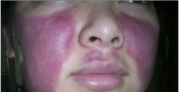 系統性紅斑狼瘡診斷標準 (38) 