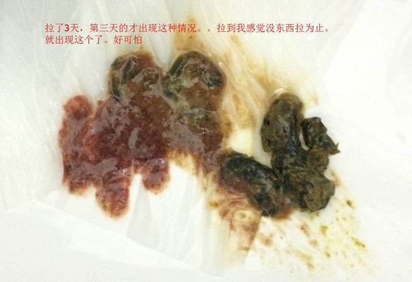 腸癌的症狀 (40) 