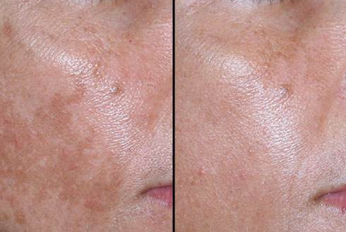 磨皮手術效果圖 (55) 