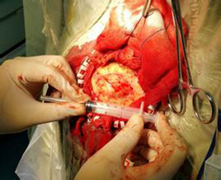 煙霧病遺傳的模式圖 