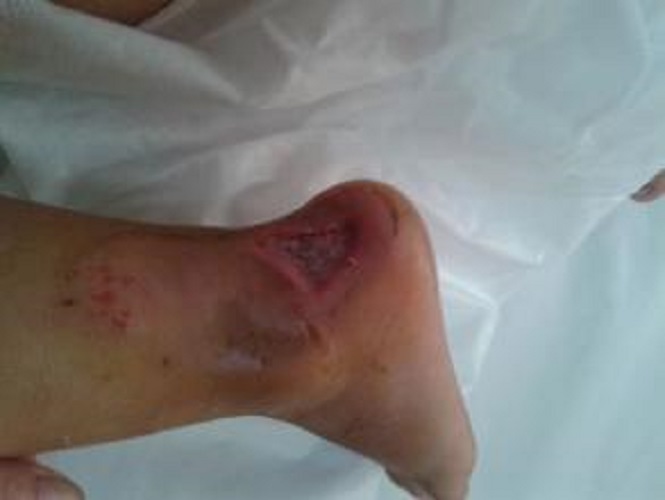 為打破傷風發炎的