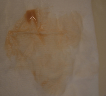 先兆流產分泌物