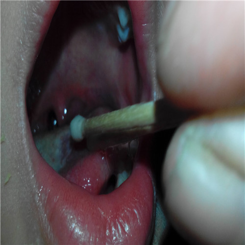 呼吸道感染咽拭子取樣