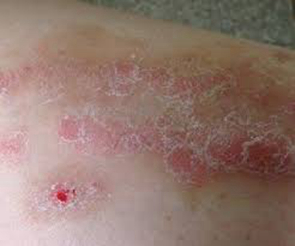 部分結痂異位性皮炎皮膚