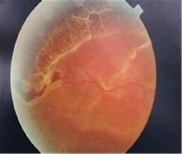 眼底視網膜脫落