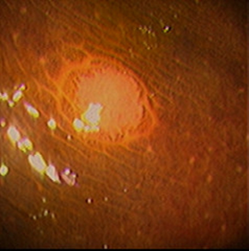 急性胃炎症狀有哪些