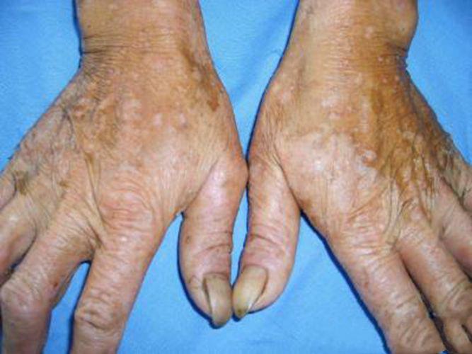 手部過敏溼疹的