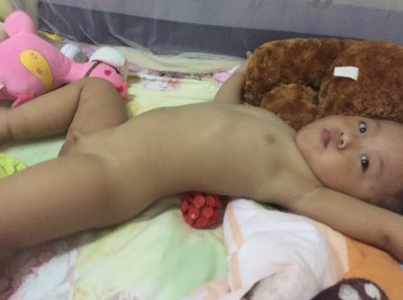 寶寶缺鈣雞胸圖 (57) 