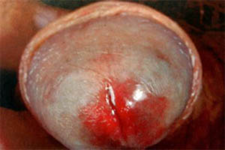 漿細胞性包皮龜頭炎急性淺表性包皮龜頭炎