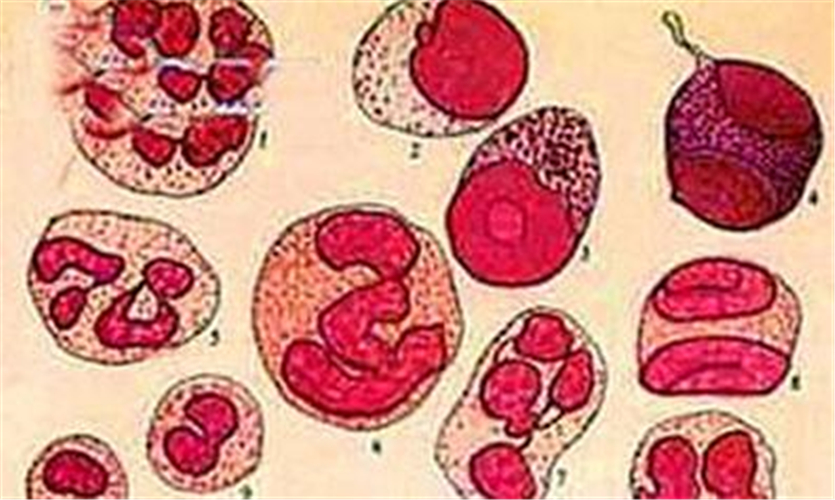 再生障礙性貧血
