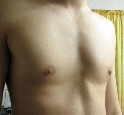 男生胸部突出 (5) 