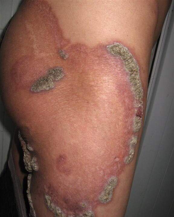 重度皮膚結核病