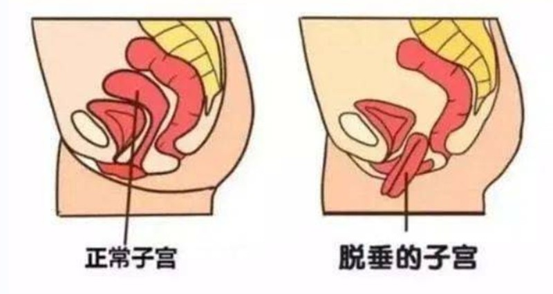 子宮脫垂如何診斷