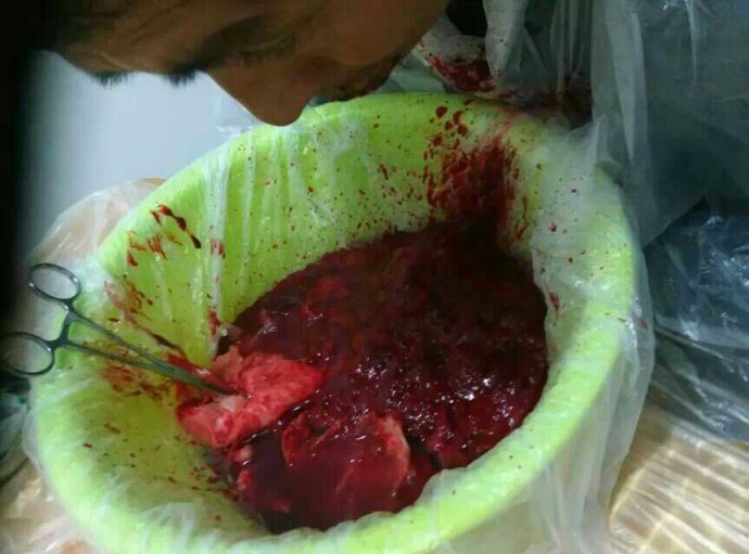 腦血栓導致腦血管痙攣治療