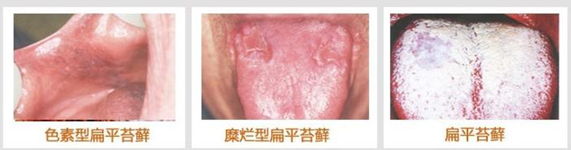 扁平苔蘚的病因有哪些 