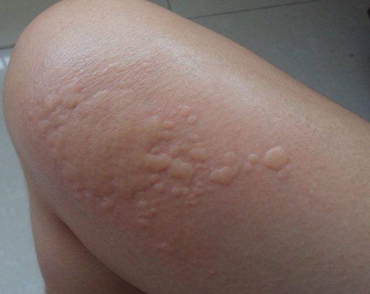 體內有寄生蟲的症狀 (65) 