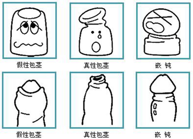 嵌頓包莖自我解救方法 