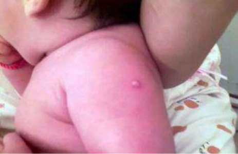 慢性淋巴結炎 (45) 