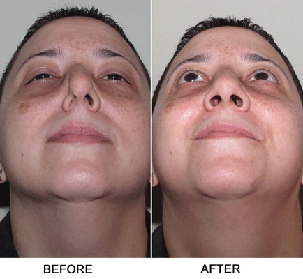 鼻中隔彎曲手術圖解 (45) 