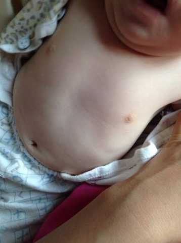 寶寶缺鈣雞胸圖 (46) 