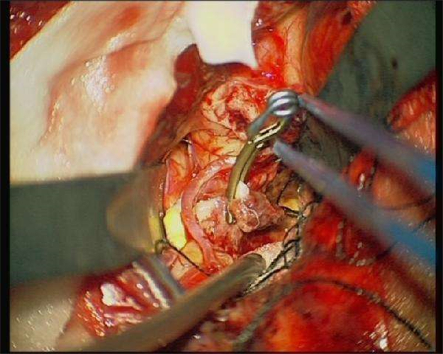 手術治療腦血管痙攣合併動脈瘤