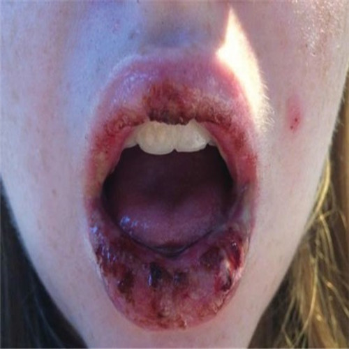 呼吸道感染引發其他疾病