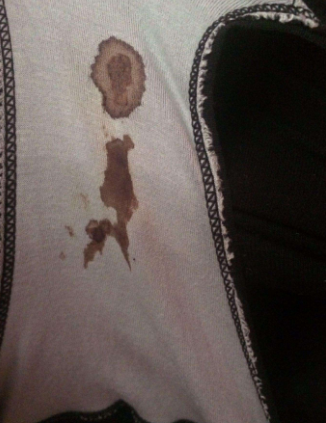 白帶帶有褐色分泌物 (65) 