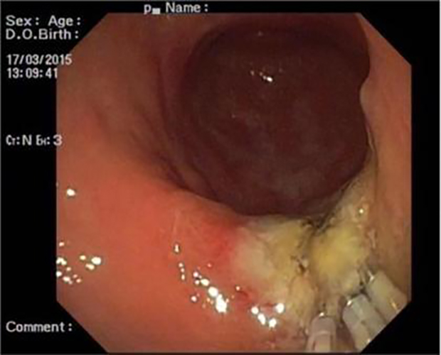 炎症胃息肉什麼症狀