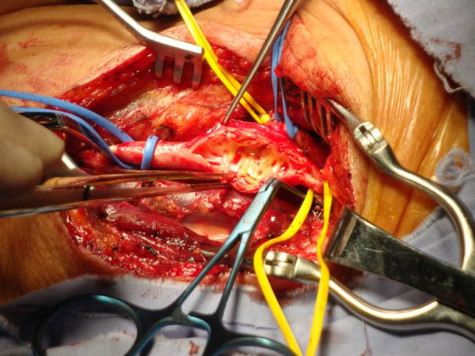 手術治療中的腦梗塞