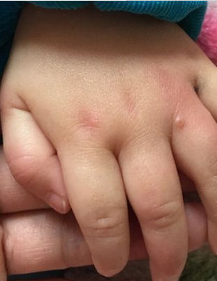 長水痘的症狀 (9) 