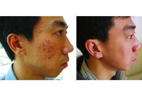 磨皮手術效果圖 (9) 