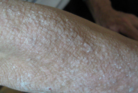 皮膚澱粉樣變 (6) 