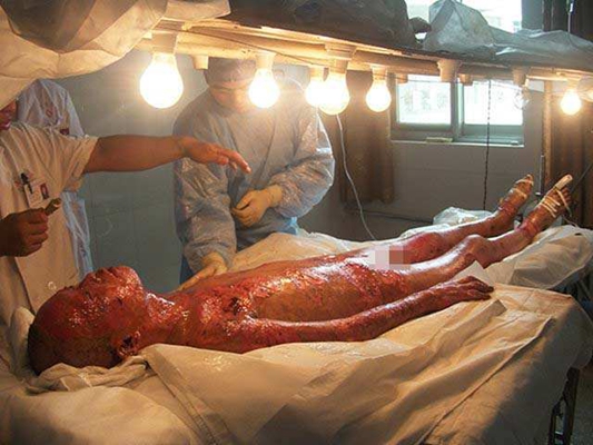 深二度燒傷 (37) 